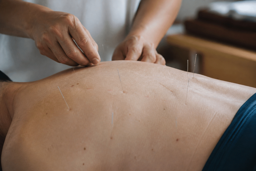 Aiguilles d'acupuncture sur points corporels marqués