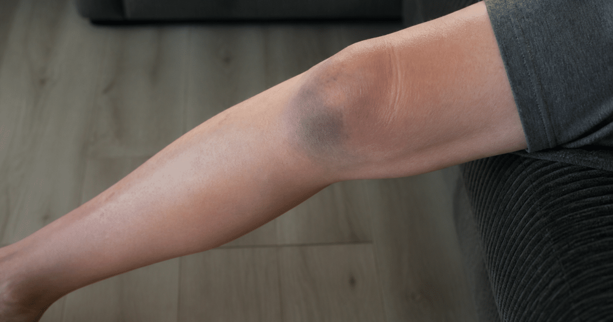 Jambe tendue montrant bleu violet gonflé sous peau genou