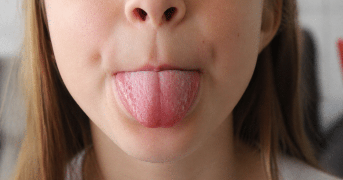 Langue gonflée avec marques blanches de dents visibles dessus