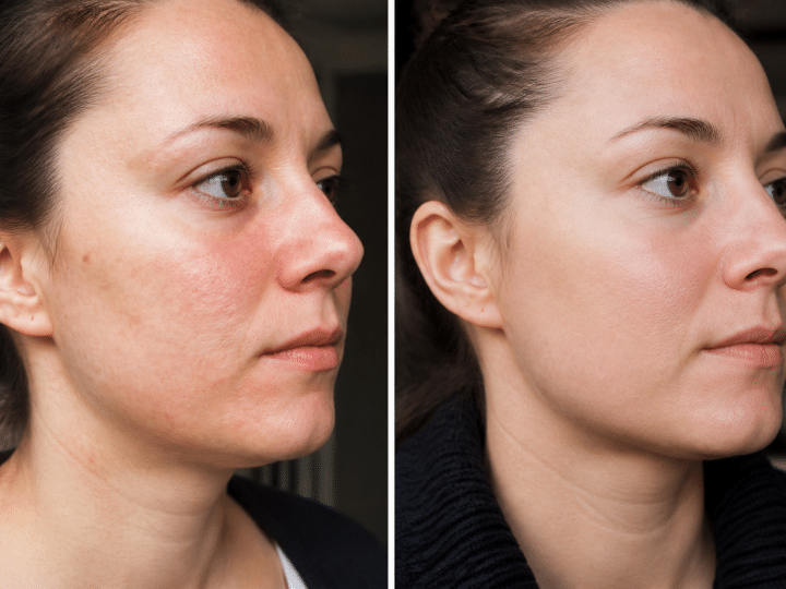 Peau du visage avant apres transition cigarette vapotage