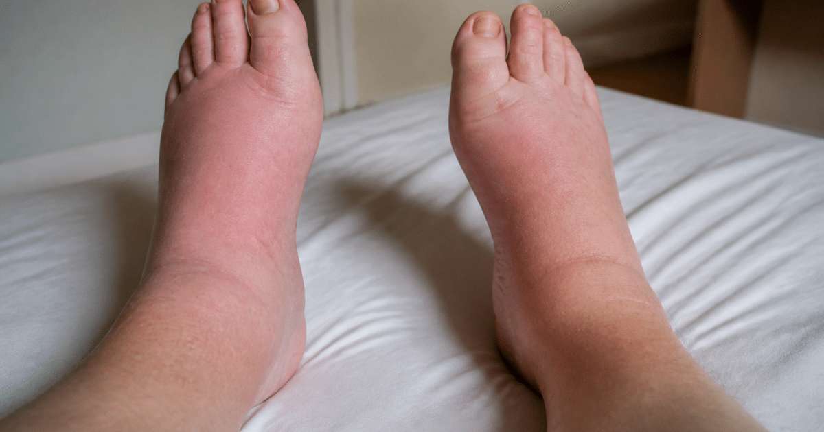 Pieds gonflés et rouges posés sur lit blanc