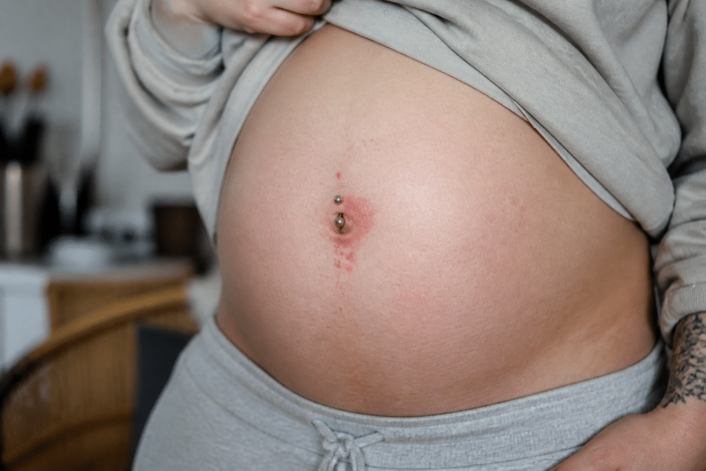 Femme enceinte avec piercing au ventre montrant irritation cutanée